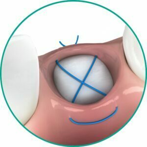 Hechten in extractie socket management