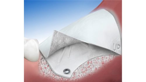 OpenTex®TR samen met Geistlich Bio-Oss® en Geistlich Bio-Gide®